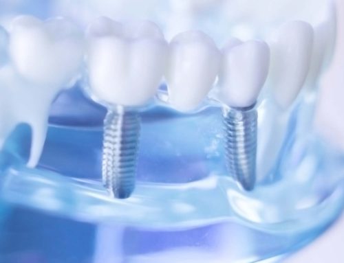 Fogbeültetés (implantáció) lépésről lépésre