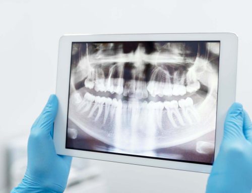 Ha a gyökérkezelés nem elég